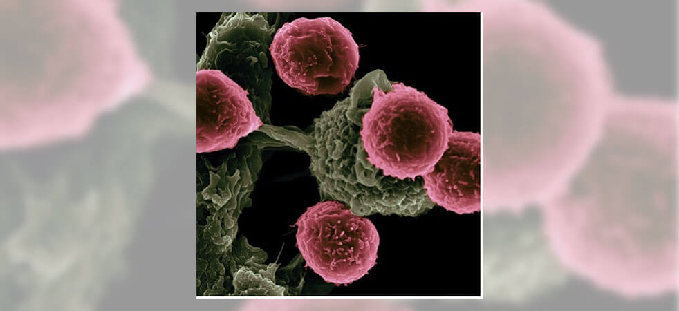 Silicosis